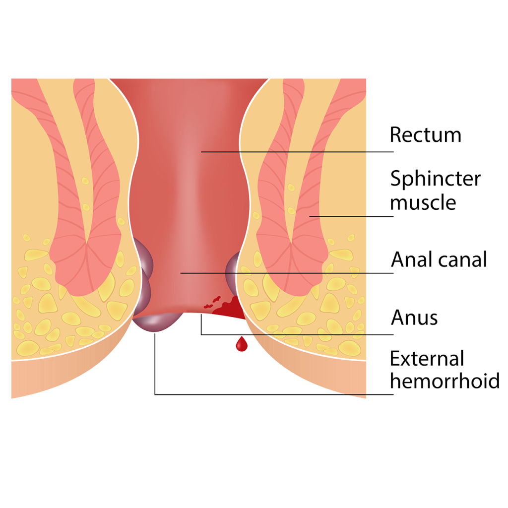haemorrhoids (piles) haemorrhoids (piles)